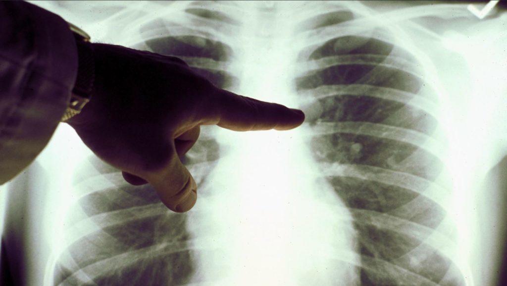 Бахмутские врачи делают вчетверо больше рентген-исследований, чем это допустимо