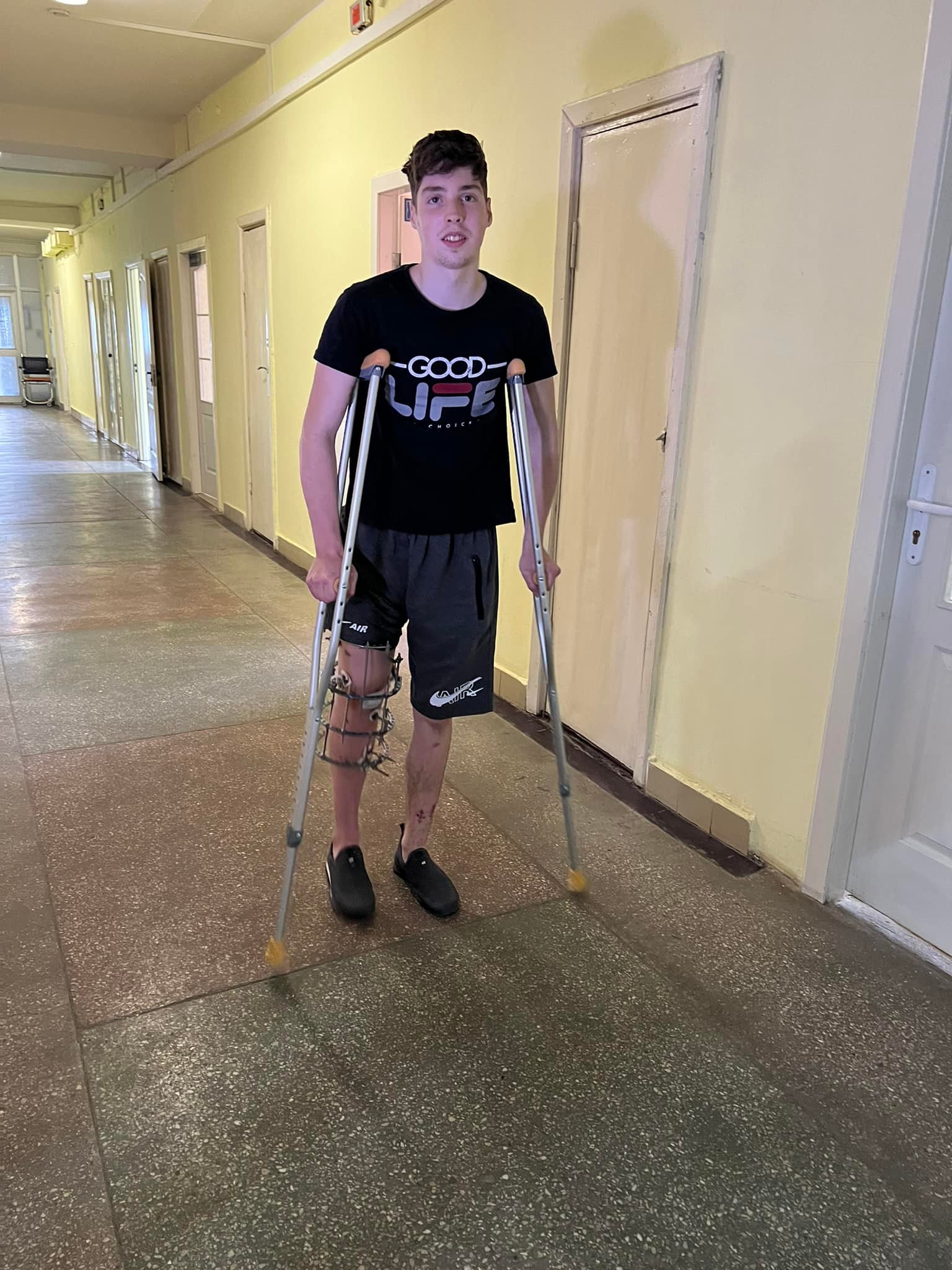 Ледь не втратив ногу через загарбників. 17-річний волонтер з Сєвєродонецька отримає колінні протези 4