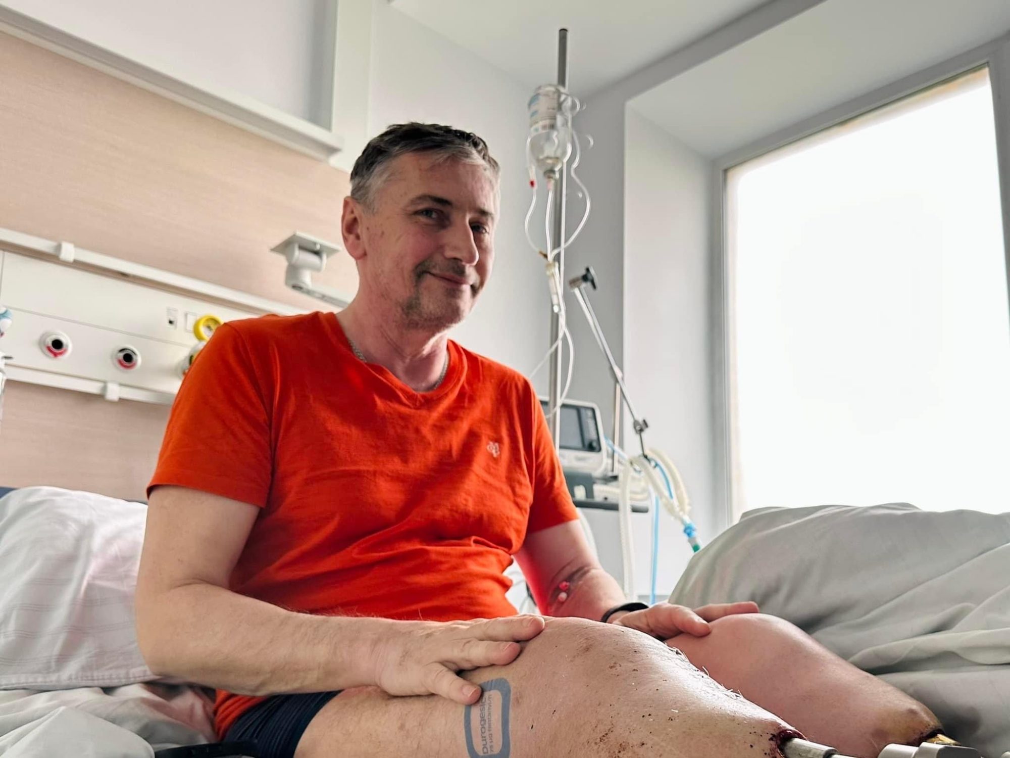 Львовские медики впервые в Украине вживили протез прямо в кость, пациентом стал военный 1