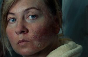 Женщинам, пострадавшим от войны, предлагают коррекцию шрамов бесплатно: как зарегистрироваться